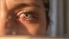 # Find Out Why Blood Vessels in Your Eyes Are Bursting

## What Is a Burst Blood Vessel in the Eye?
