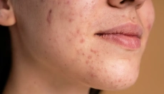Hormonal acne and ways to treat it