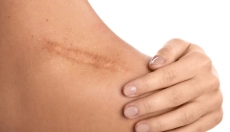 Get Rid of Scars with Proven Scar Wonders